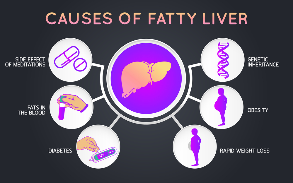 Causes of Fatty Liver Disease