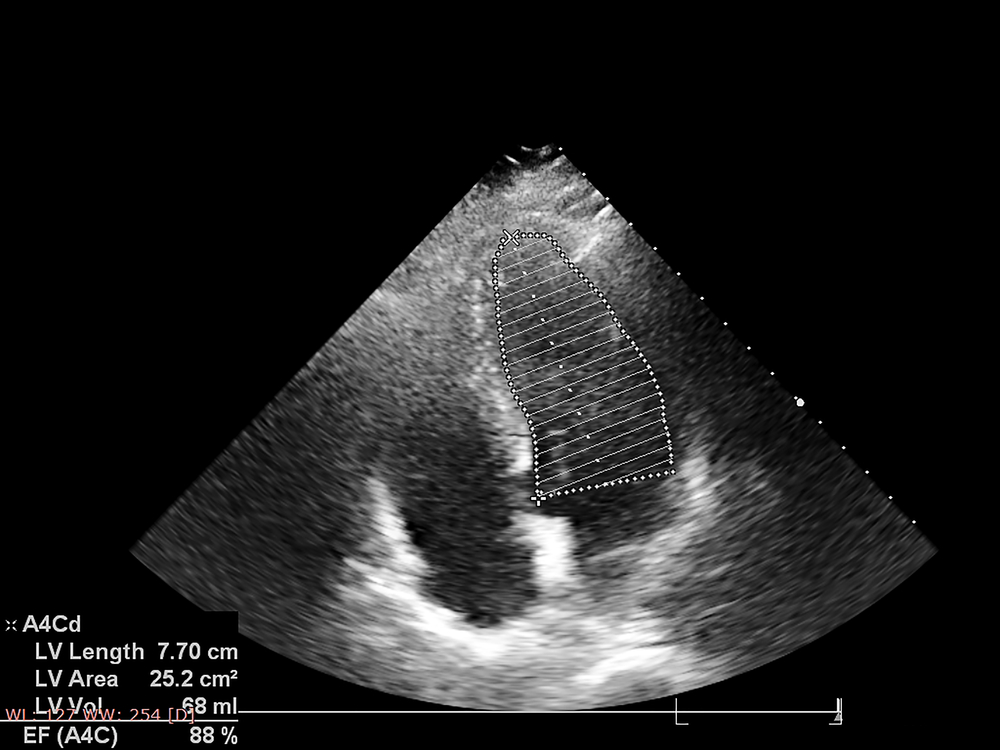 echocardiogram