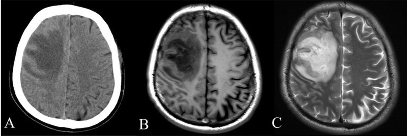 CT Scan of brain vs MRI