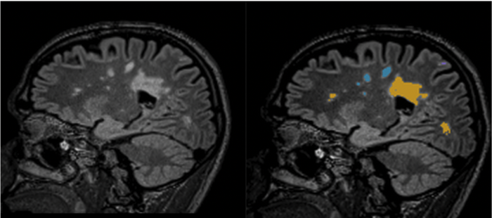 Isometrix image of brain with MS