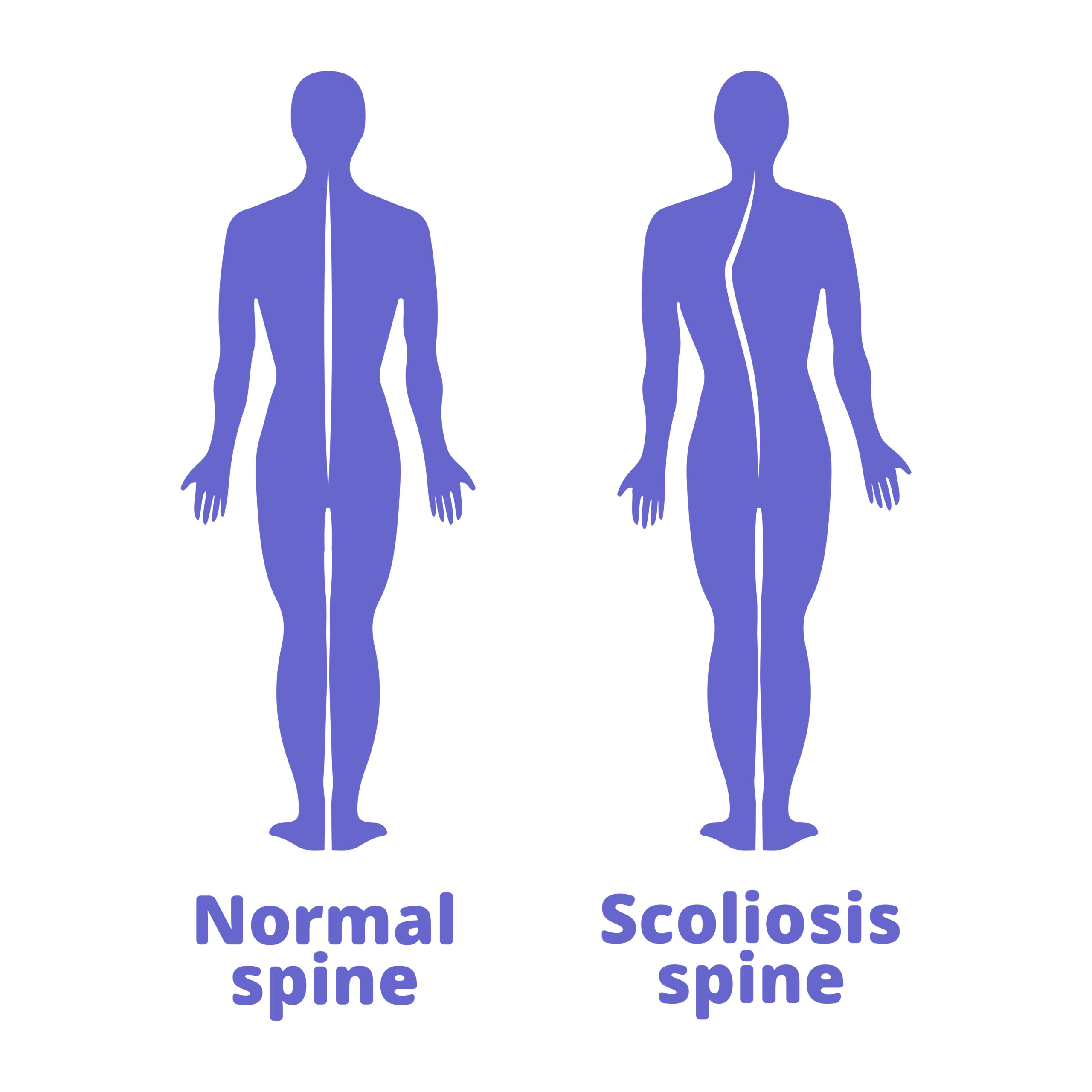 Scoliosis spine